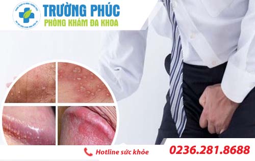 Ngứa bao quy đầu nguyên nhân do đâu?