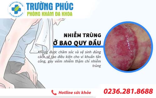 5 dấu hiệu điển hình của bệnh viêm bao quy đầu