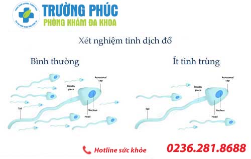 Bệnh tinh trùng ít ở nam giới và phương pháp điều trị hiện nay