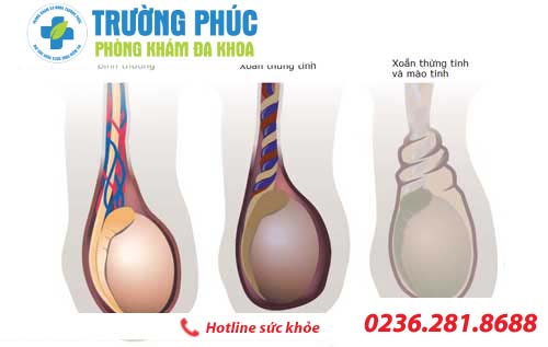 benh tinh trung it o nam gioi va phuong phap dieu tri 