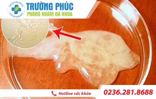 tinh trung loang va phuong phap ho tro dieu tri
