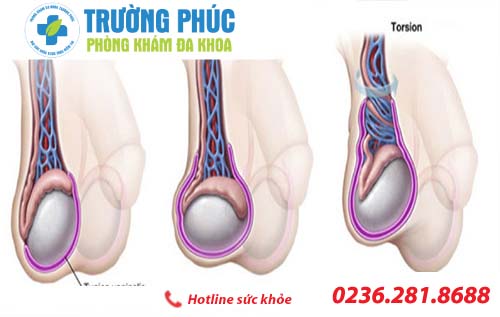 Bệnh xoắn tinh hoàn và phương pháp hỗ trợ điều trị