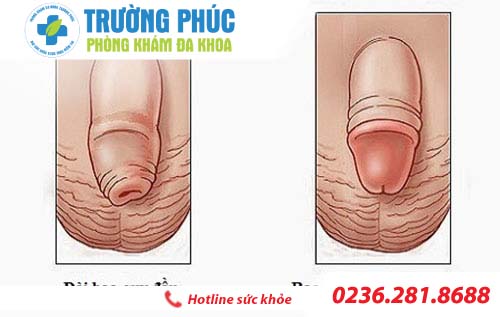 Làm sao để phân biệt  dài bao quy đầu  và hẹp bao quy đầu ?