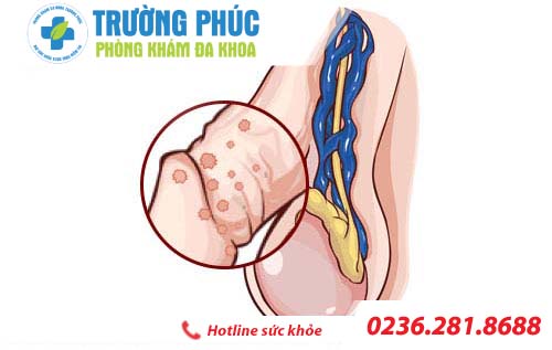 Các bệnh thường gặp ở dương vật nam giới nên biết