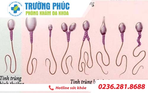 Cách nhận biết tinh trùng yếu ở nam giới