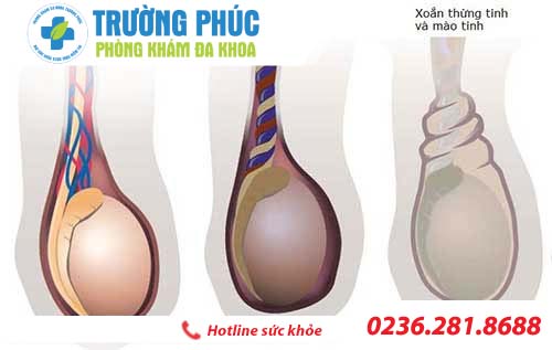 Cẩn thận với những dấu hiệu của giãn tĩnh mạch thừng tinh