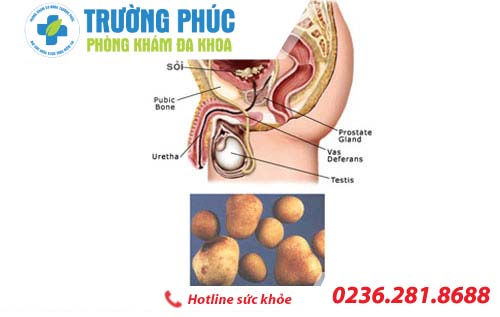 Cảnh báo dấu hiệu bệnh sỏi tuyến tiền liệt
