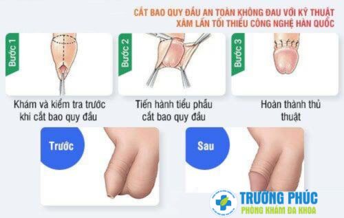 Cắt bao quy đầu an toàn không đau chi phí bình dân tại Đà Nẵng