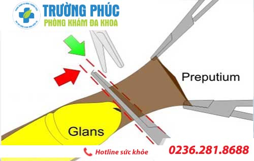 dài bao quy đầu có nên cắt không