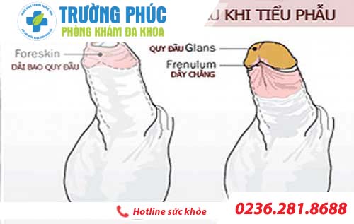 Dài bao quy đầu là do đâu?
