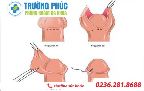 Dài bao quy đầu là do đâu? dai bao quy dau la do dau?