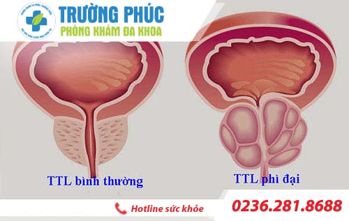 Dấu hiệu nhận biết bệnh phì đại tuyến tiền liệt