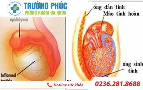 Đau tinh hoàn có dẫn đến vô sinh không?