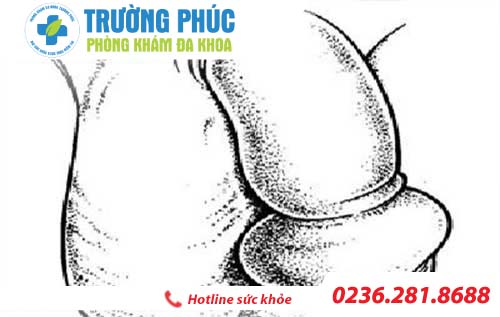 Dương vật bị sưng và phương pháp hỗ trợ điều trị hiện nay