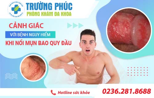 Cảnh giác với bệnh nguy hiểm khi nổi mụn bao quy đầu