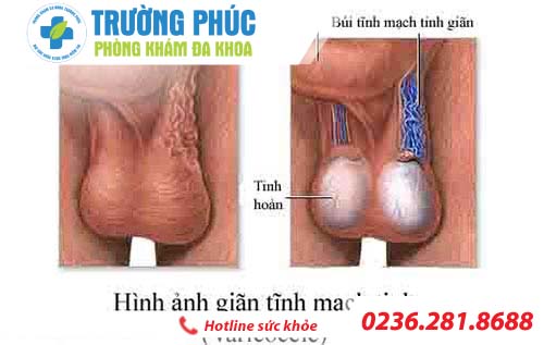 Nguyên nhân dẫn đến nam giới có tinh trùng ít