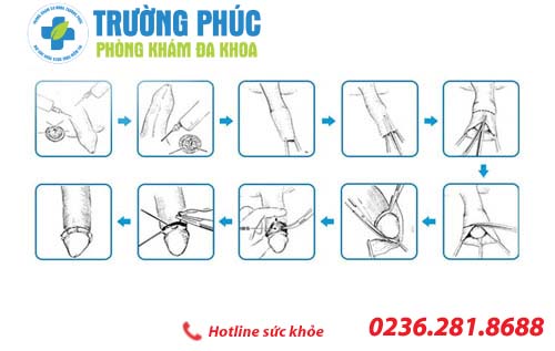 Nguyên nhân dẫn đến viêm bao quy đầu là gì?