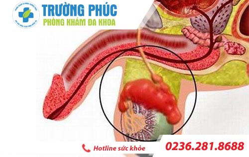 nhung benh lien quan den tinh hoan