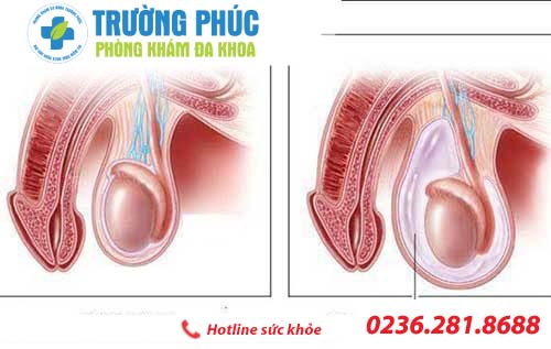 Những triệu chứng nguy hiểm của chứng tràn dịch màng tinh hoàn