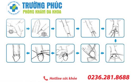 phuong phap dieu tri hep bao quy dau