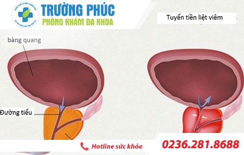 phương pháp hỗ trợ điều trị viêm tuyến tiền liệt ở nam giới