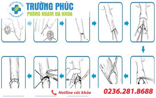 Quy trình cắt bao quy đầu