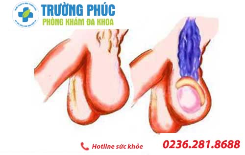 Sưng một bên tinh hoàn bác sĩ chuyên khoa tư vấn