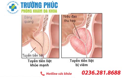 sung mot ben tinh hoan - bac si chuyen khoa tu van 