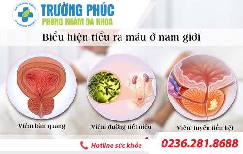 Tiểu ra máu ở nam giới là biểu hiện của bệnh lý nào?