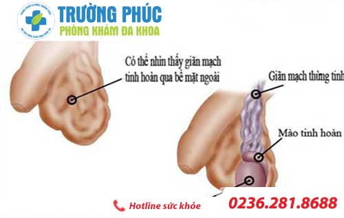 Tìm hiểu bệnh giãn tĩnh mạch tinh hoàn