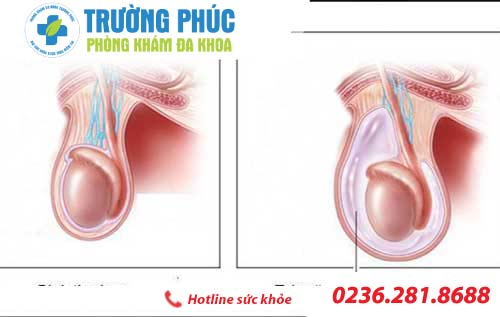 tim hieu benh tran dich mang tinh hoan