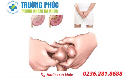 Tìm hiểu tinh hoàn có cục cứng nhỏ
