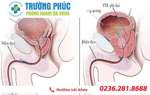tim hieu ve benh phi dai tuyen tien liet