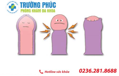 Hẹp bao quy đầu là gì? Làm sao để khắc phục?