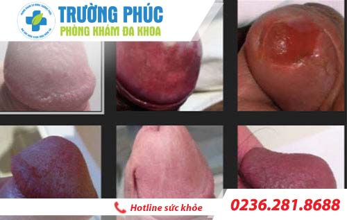 trieu chung viem bao quy dau