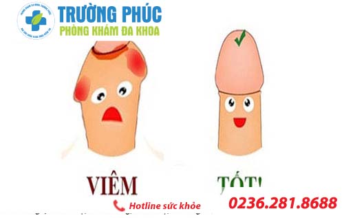 Triệu chứng bệnh viêm bao quy đầu thường gặp