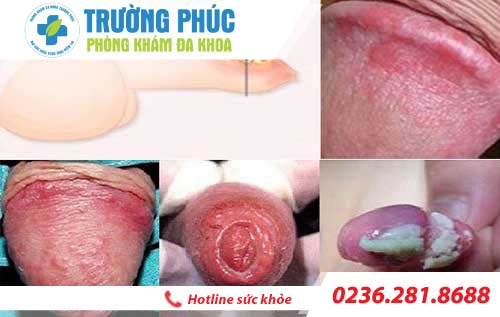 thong tin benh viem duong vat