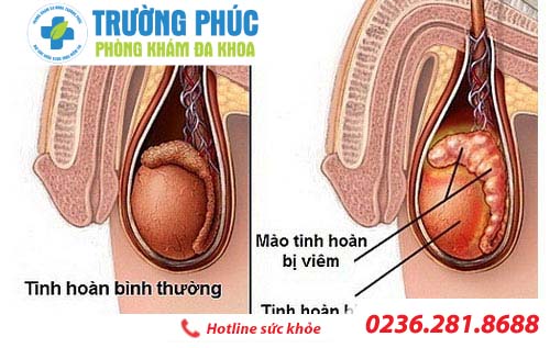 Viêm tinh hoàn có gây vô sinh ở nam giới ?