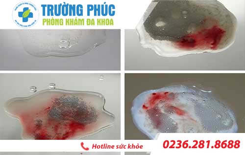 xuat tinh ra mau dau hieu cho nen xem nhe